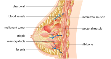 breast cancer image | Arizona Advanced Surgery