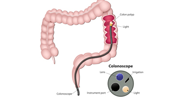 Colon Resection Image | Arizona Advanced Surgery