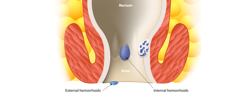 Hemorrhoids Treatment Image | Arizona Advanced Surgery