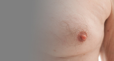 Male Breast Reduction Image | Arizona Advanced Surgery