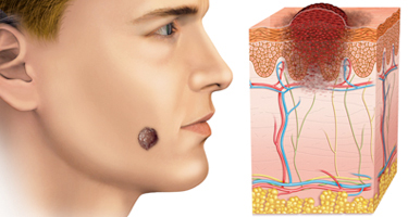 Melanoma & Soft Tissue Sarcoma Image | Arizona Advanced Surgery